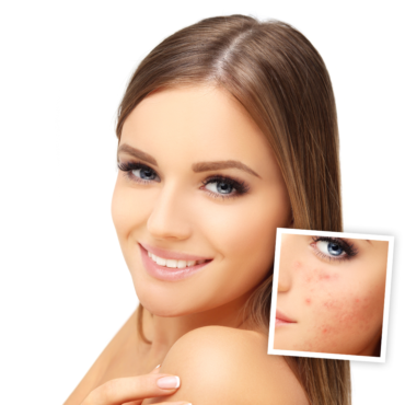 Customized Micro needling for indented Marks/ Post Acne Scars | 45 Minutes