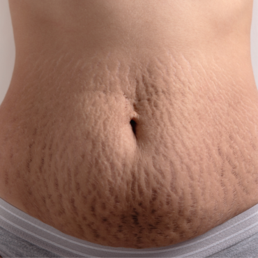Scar Camouflage, Inkless & Stretch Mark Technique Training