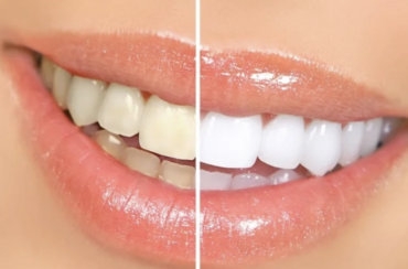 Teeth Whitening Second Session Touch Up