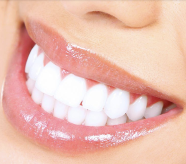 Teeth Whitening – Package of 3 Sessions