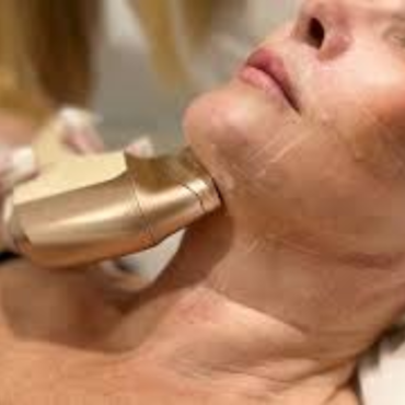 Non surgical Face lift HIFU (Double Chin) | 30 minutes