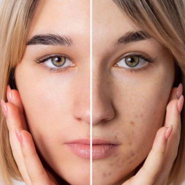 Customized Chemical Peel for Indented Marks/ Active Acne/Post Acne Scars | 45 Minutes