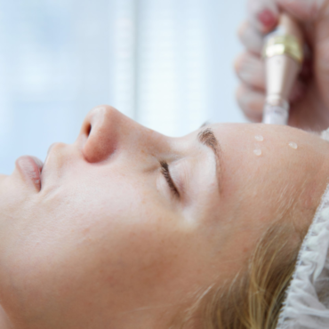 2 Treatments of Micro Channeling or Microneedling Treatments | 45 minutes