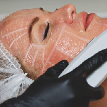 Non Surgical Face Lift (HIFU) | 40 Minutes