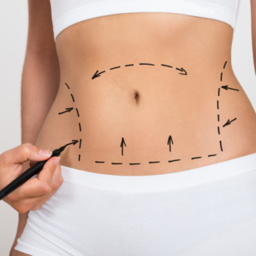 CRYOTEC Cryolipolysis Abdomen Center or Love Handle | 1 hr