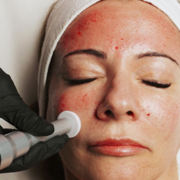 Microchanneling with LED Treatment Revisit(prepaid) | 30 minutes
