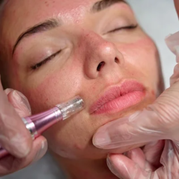 Cosmetic Micro-Needling | 45 minutes